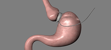 Adjustable Gastric Band Surgery