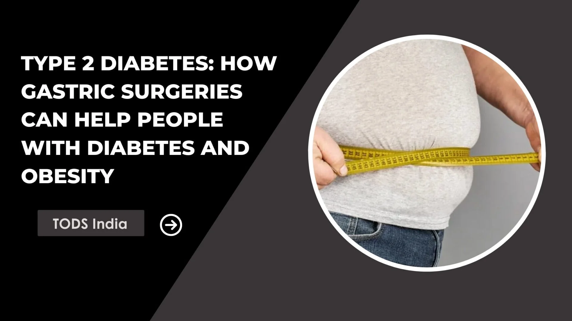 Type 2 diabetes